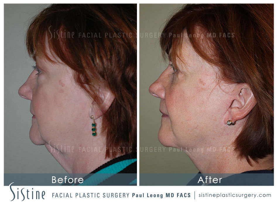 Facelift Before And After Leong Facial Plastic Surgery