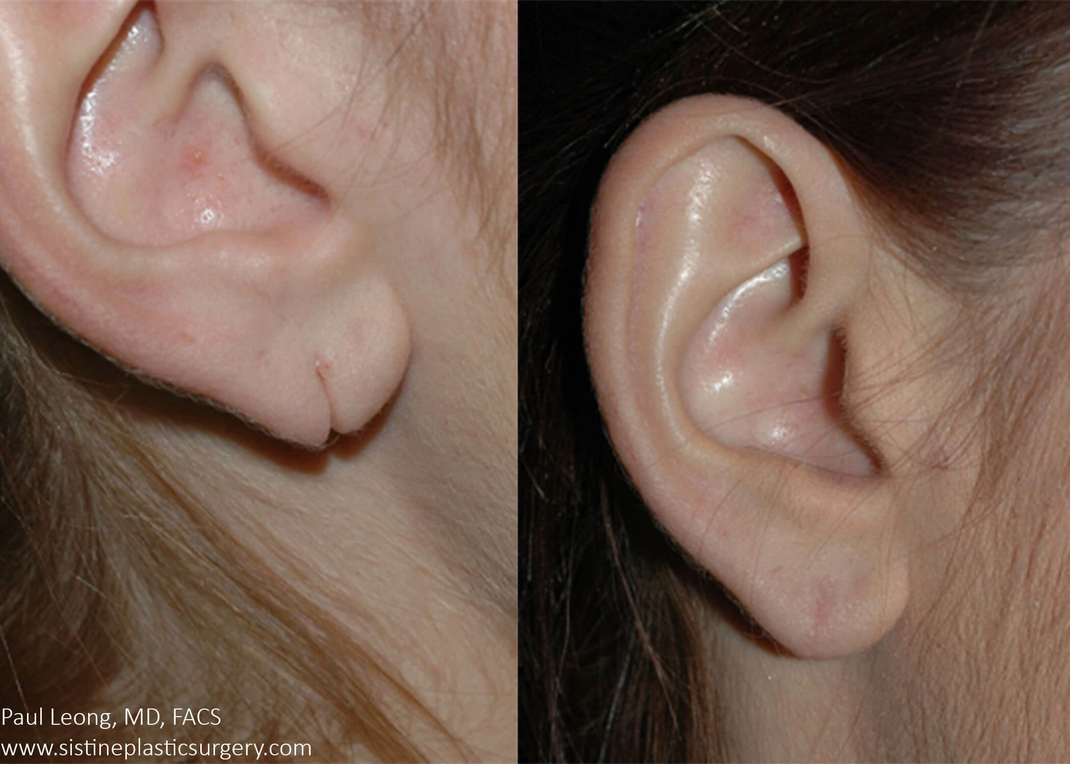 Torn Earlobes Repair and Correction - Sistine Plastic Surgery