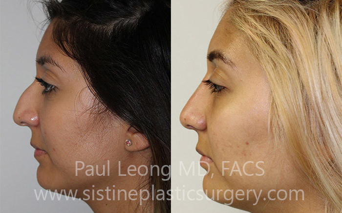 Pittsburgh, PA Rhinoplasty Surgery Dr. Paul Leong MD, FACS