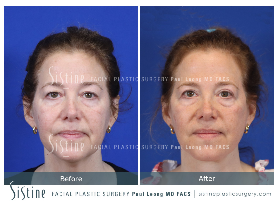 Blepharoplasty Before and After | Leong Facial Plastic Surgery