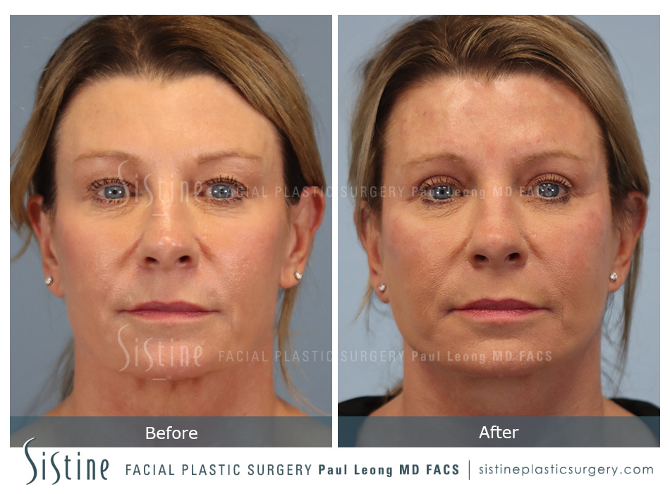 Blepharoplasty Before and After | Leong Facial Plastic Surgery