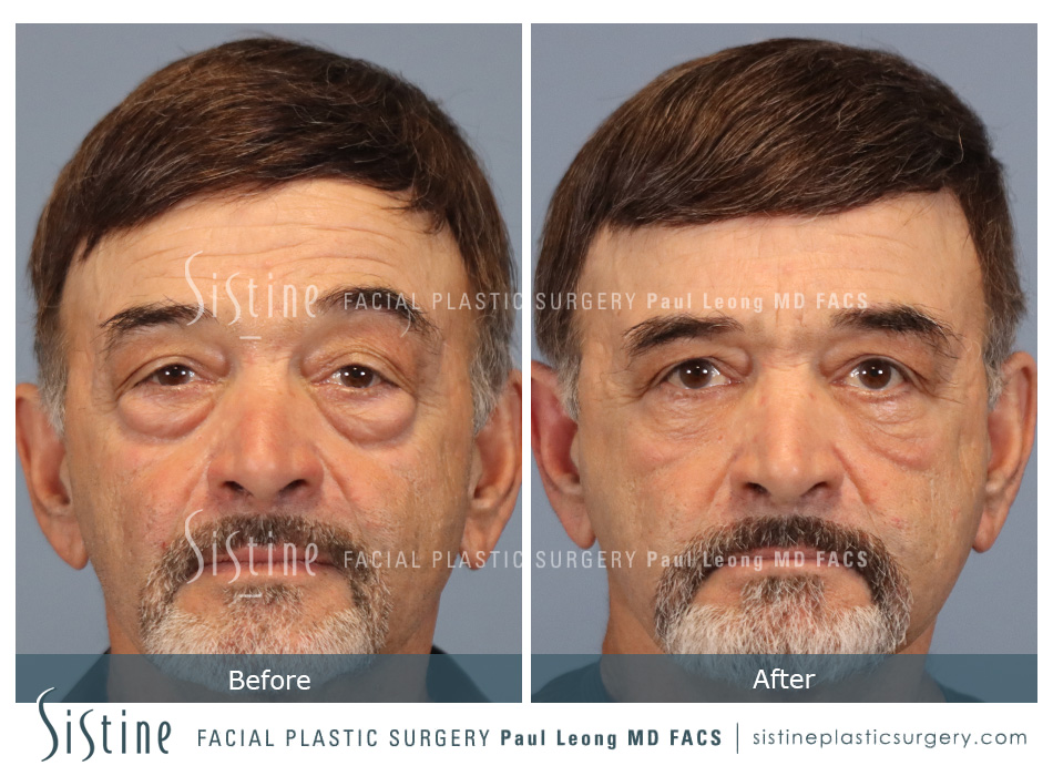 Blepharoplasty Before and After | Leong Facial Plastic Surgery