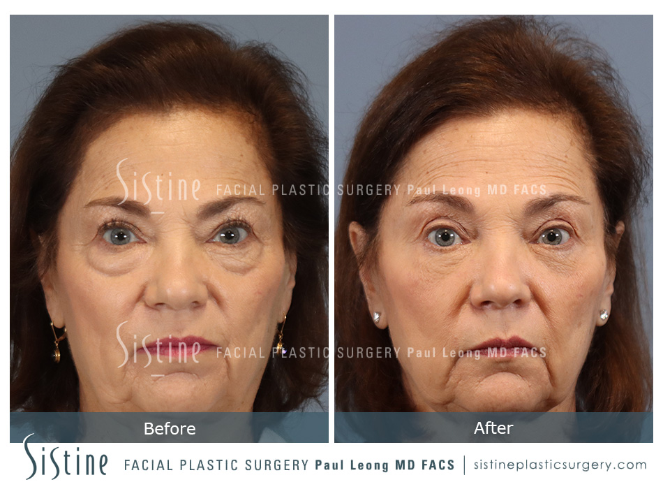 Blepharoplasty Before and After | Leong Facial Plastic Surgery