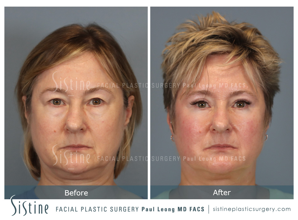 Blepharoplasty Before and After | Leong Facial Plastic Surgery