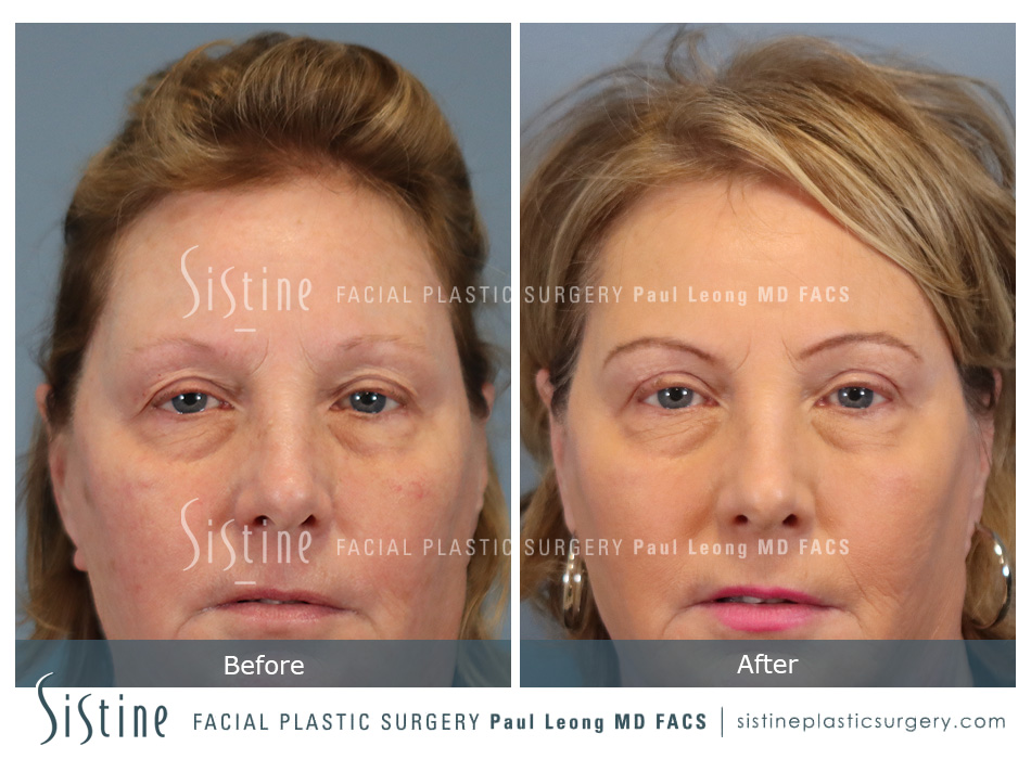 Blepharoplasty Before and After | Leong Facial Plastic Surgery