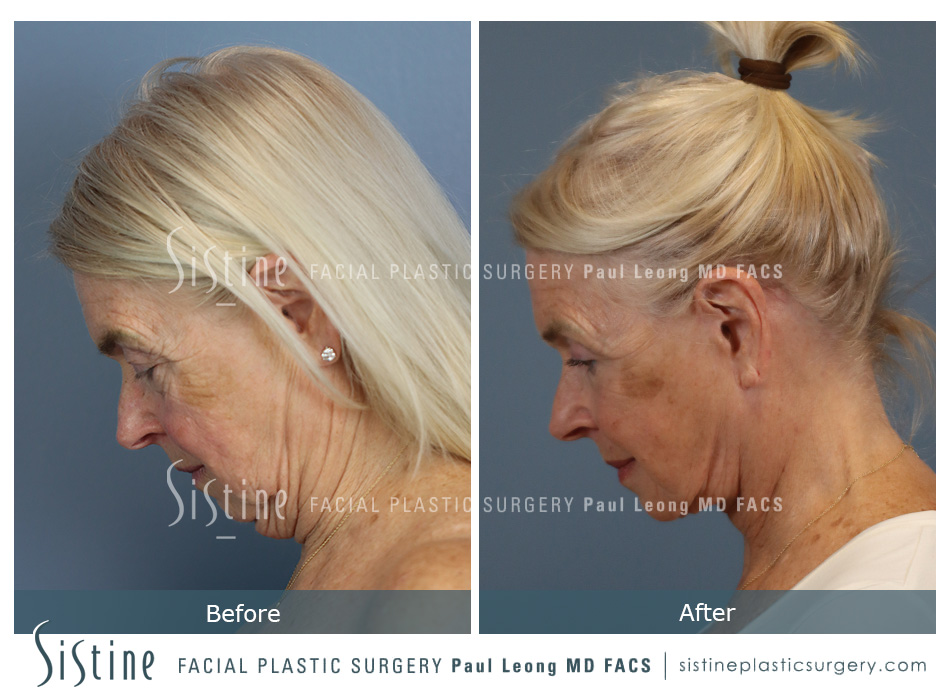 Blepharoplasty Before and After | Leong Facial Plastic Surgery