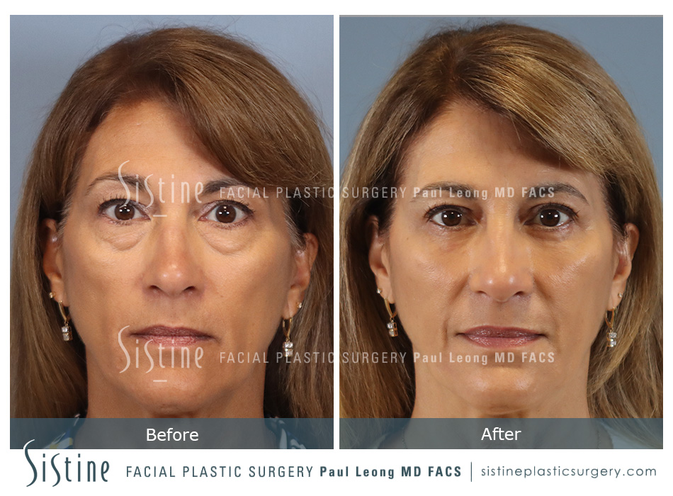 Blepharoplasty Before and After | Leong Facial Plastic Surgery