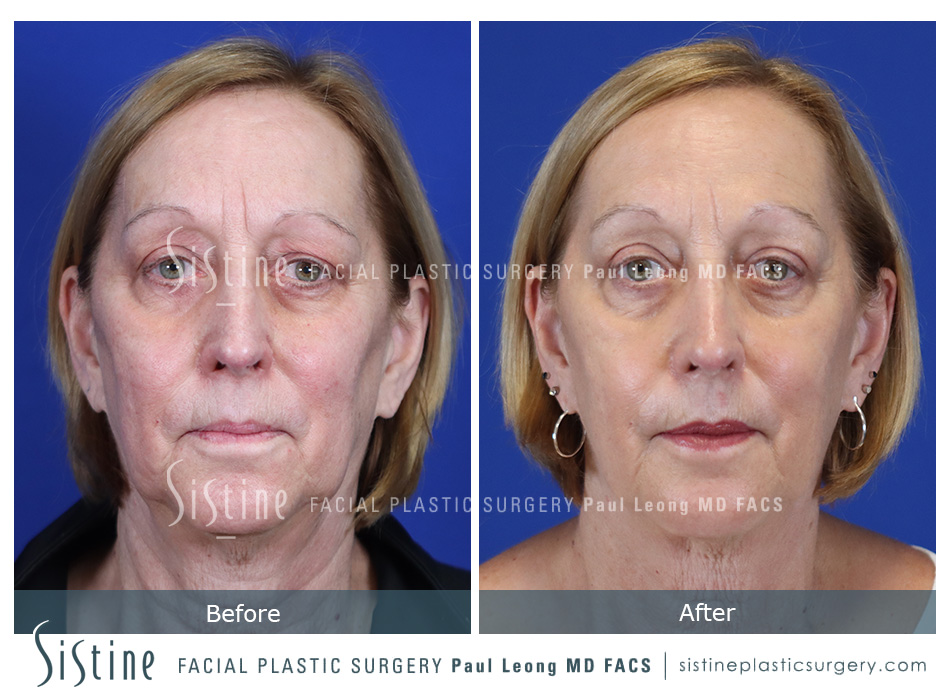 Blepharoplasty Before and After | Leong Facial Plastic Surgery