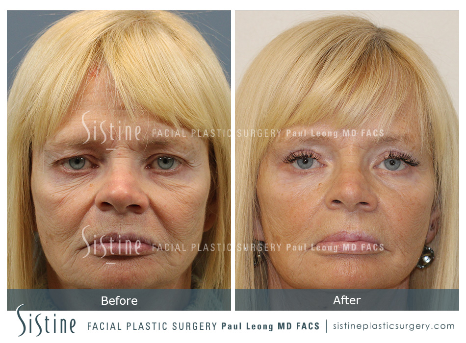 Blepharoplasty Before and After | Leong Facial Plastic Surgery