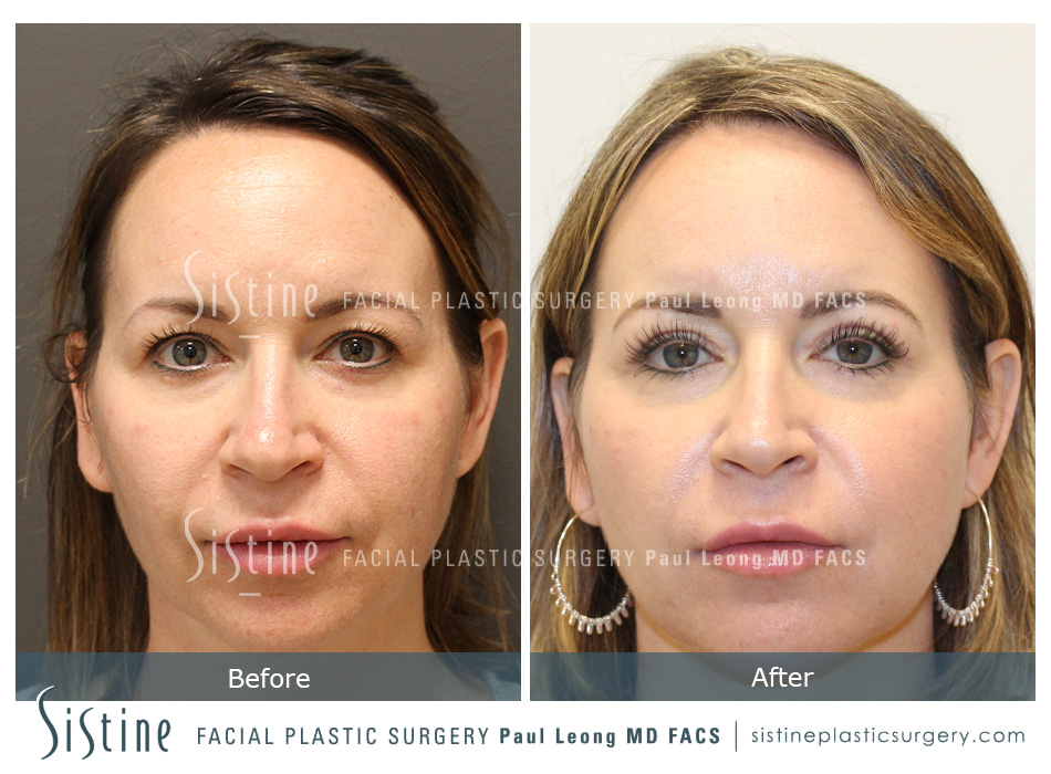 Blepharoplasty Before and After | Leong Facial Plastic Surgery