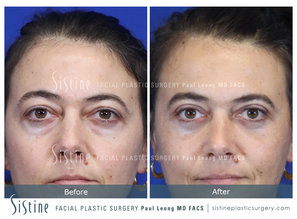 Blepharoplasty Before and After | Leong Facial Plastic Surgery