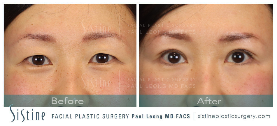 Blepharoplasty Before and After | Leong Facial Plastic Surgery