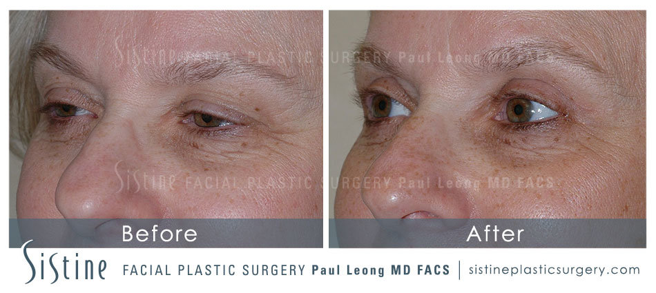 Blepharoplasty Before and After | Leong Facial Plastic Surgery