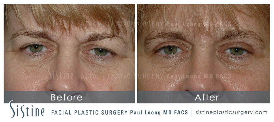 Blepharoplasty Before and After | Leong Facial Plastic Surgery