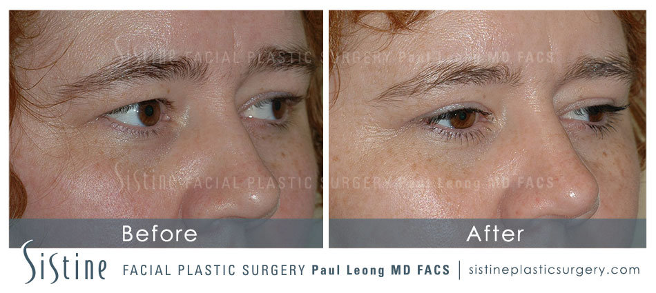 Blepharoplasty Before and After | Leong Facial Plastic Surgery