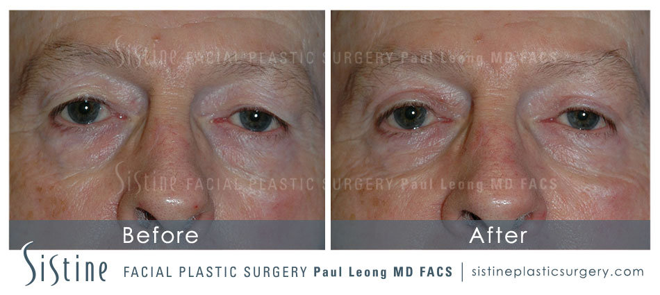 Blepharoplasty Before and After | Leong Facial Plastic Surgery