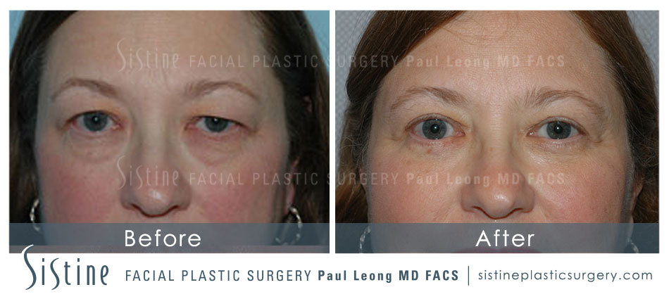 Blepharoplasty Before and After | Leong Facial Plastic Surgery