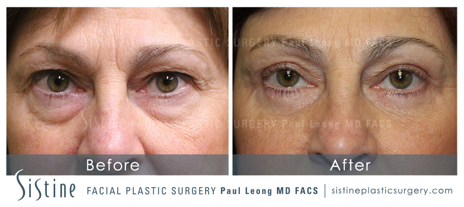 Blepharoplasty Before and After | Leong Facial Plastic Surgery