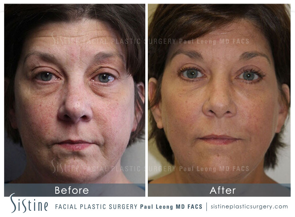 Blepharoplasty Before and After | Leong Facial Plastic Surgery