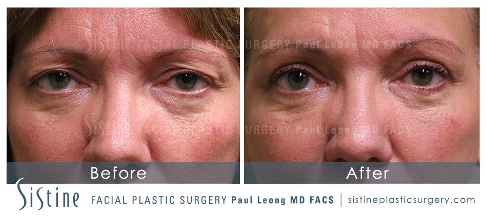 Blepharoplasty Before and After | Leong Facial Plastic Surgery