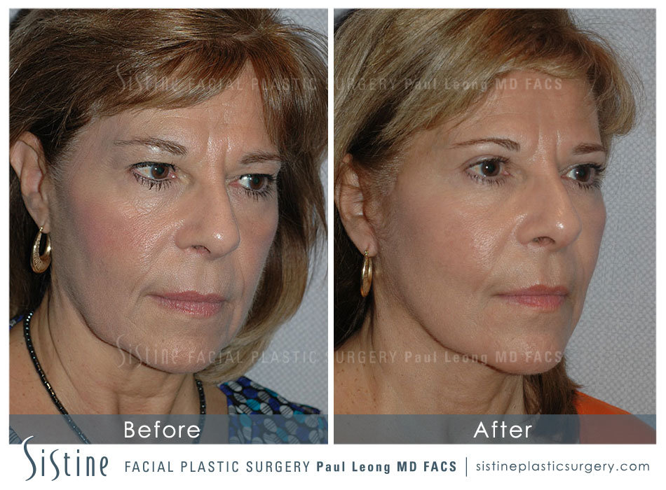 Blepharoplasty Before and After | Leong Facial Plastic Surgery