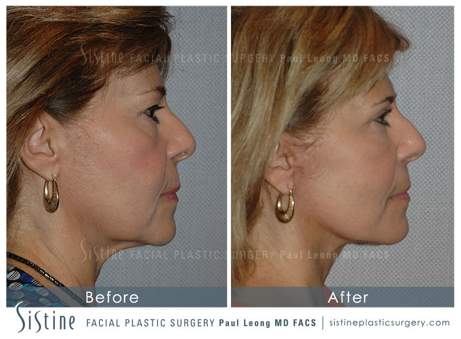 Blepharoplasty Before and After | Leong Facial Plastic Surgery