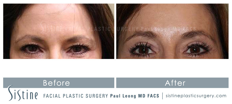 Blepharoplasty Before and After | Leong Facial Plastic Surgery