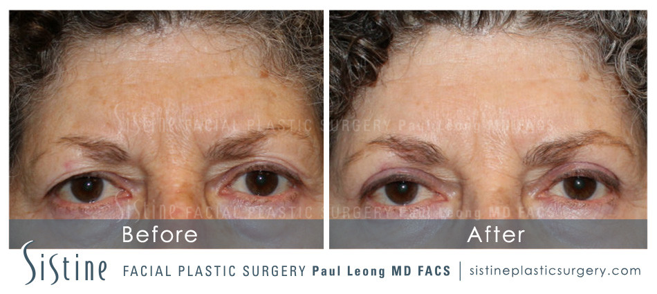 Blepharoplasty Before and After | Leong Facial Plastic Surgery