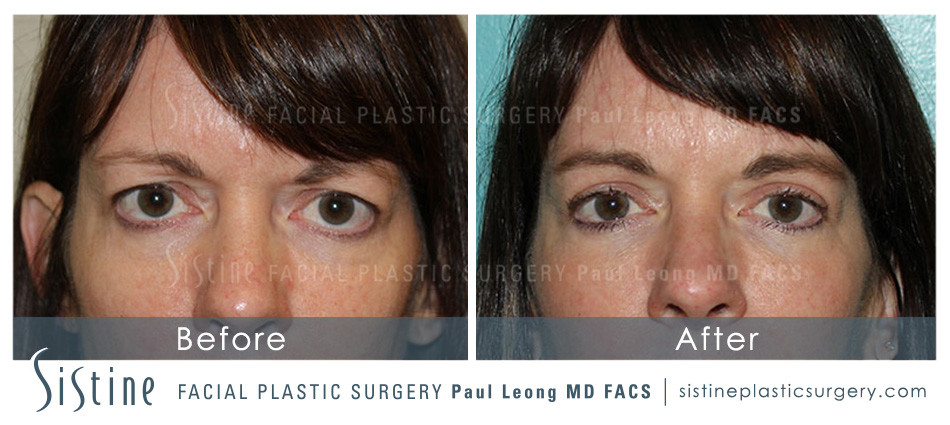 Blepharoplasty Before and After | Leong Facial Plastic Surgery