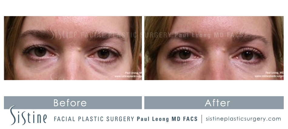 Blepharoplasty Before and After | Leong Facial Plastic Surgery