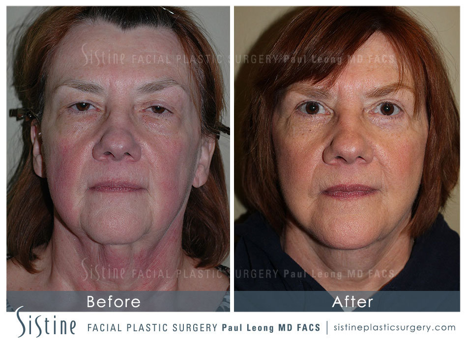 Blepharoplasty Before and After | Leong Facial Plastic Surgery