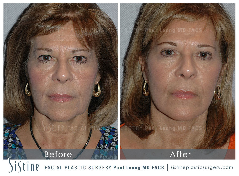 Blepharoplasty Before and After | Leong Facial Plastic Surgery