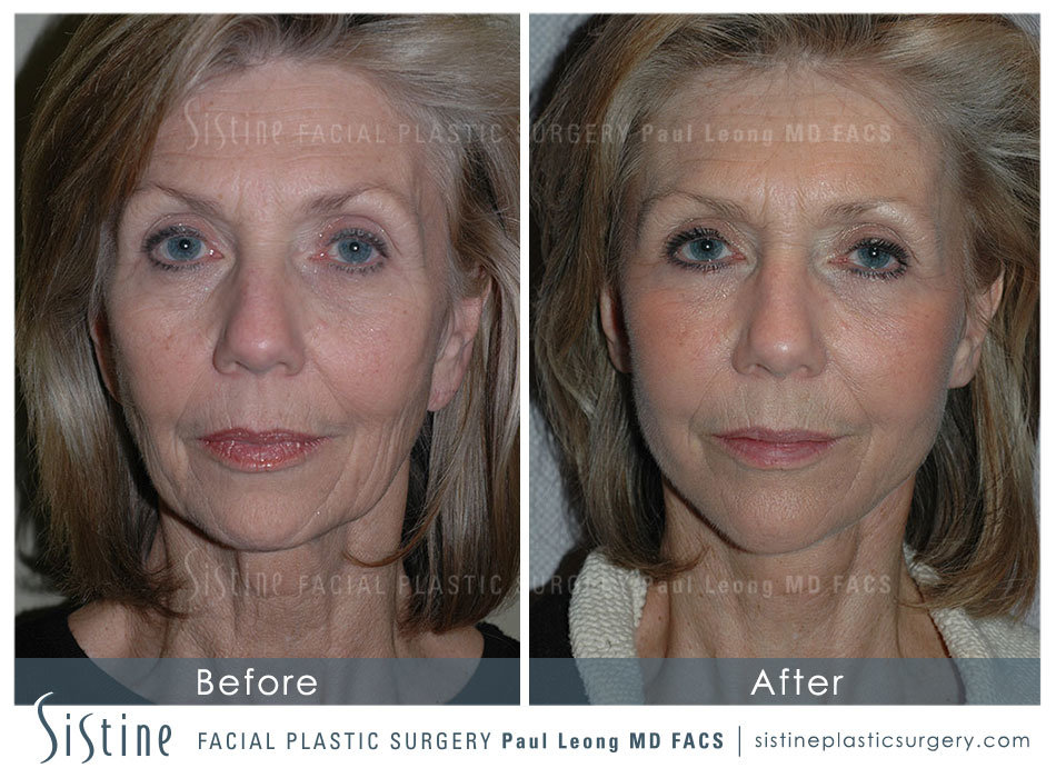 Blepharoplasty Before and After | Leong Facial Plastic Surgery