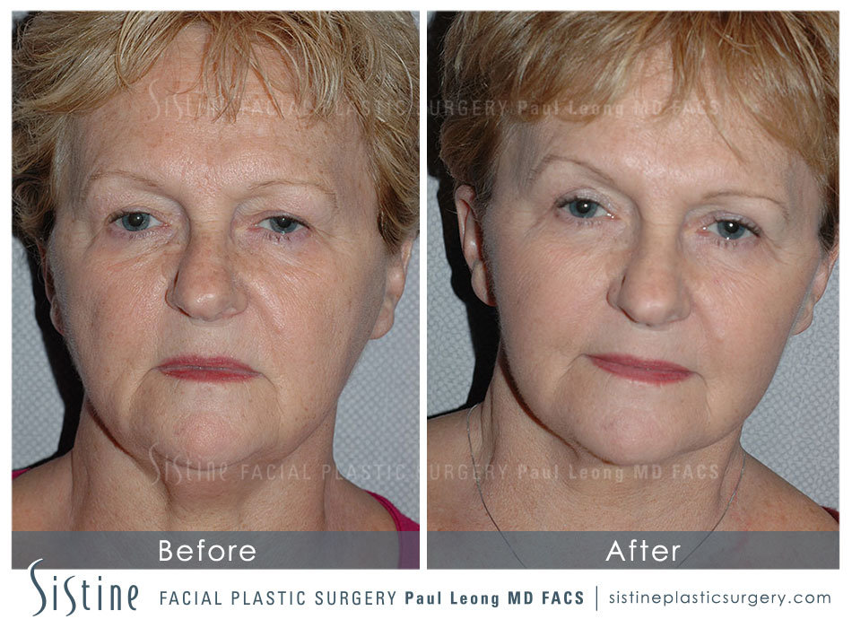 Blepharoplasty Before and After | Leong Facial Plastic Surgery