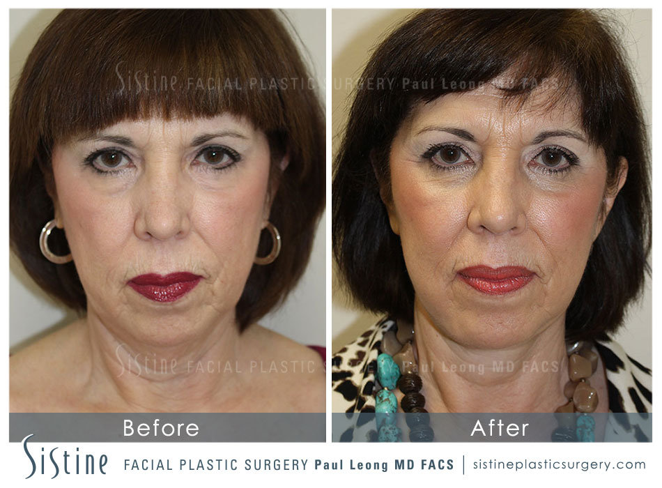 Blepharoplasty Before and After | Leong Facial Plastic Surgery