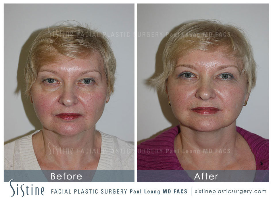 Blepharoplasty Before and After | Leong Facial Plastic Surgery