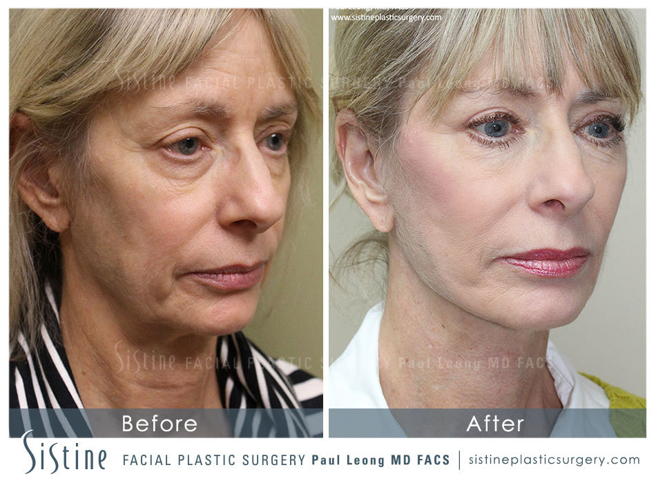 Blepharoplasty Before and After | Leong Facial Plastic Surgery