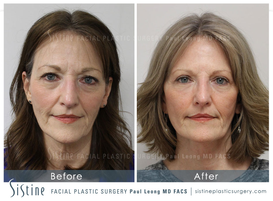 Blepharoplasty Before and After | Leong Facial Plastic Surgery