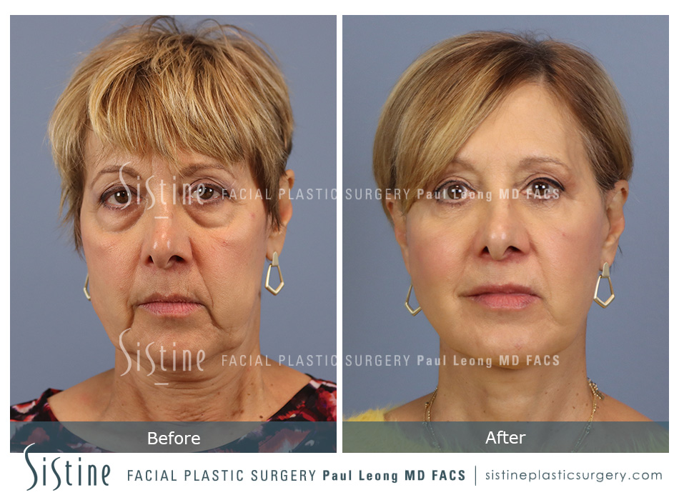 Blepharoplasty Before and After | Leong Facial Plastic Surgery