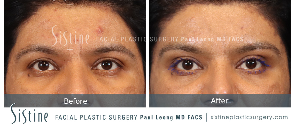 Browlift Before and After | Leong Facial Plastic Surgery