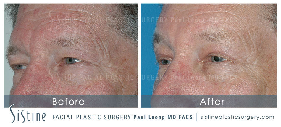 Browlift Before and After | Leong Facial Plastic Surgery