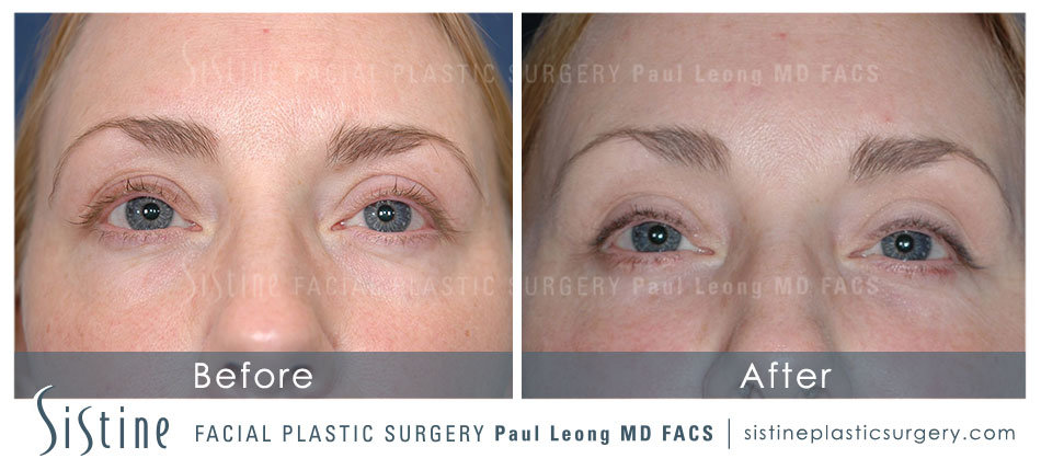 Browlift Before and After | Leong Facial Plastic Surgery