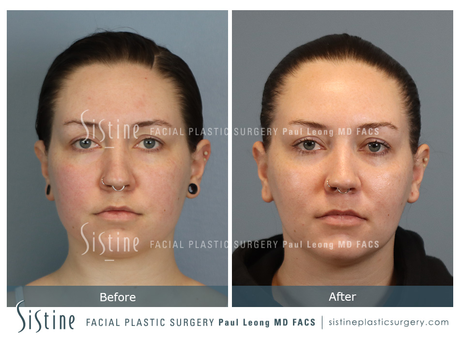 Buccal Fat Removal Before and After | Leong Facial Plastic Surgery