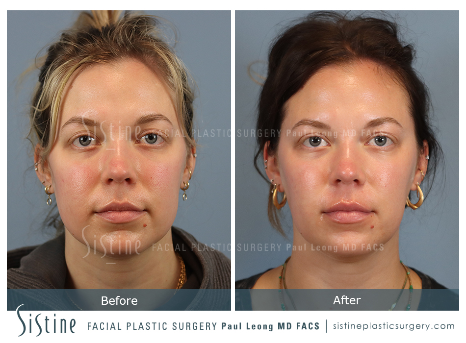 Buccal Fat Removal Before and After | Leong Facial Plastic Surgery