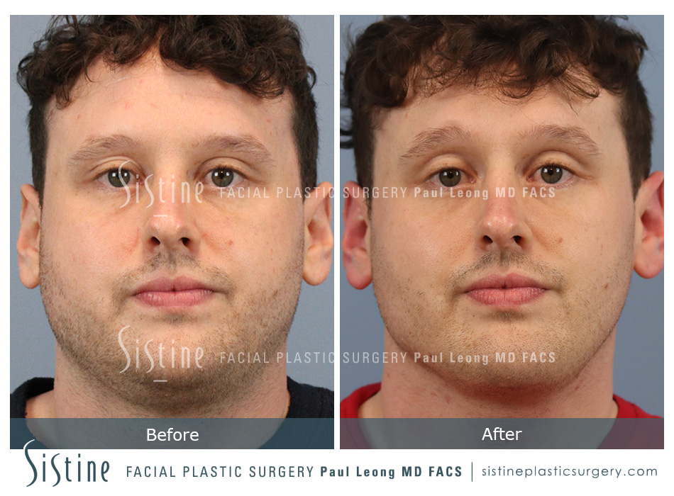 Buccal Fat Removal Before and After | Leong Facial Plastic Surgery