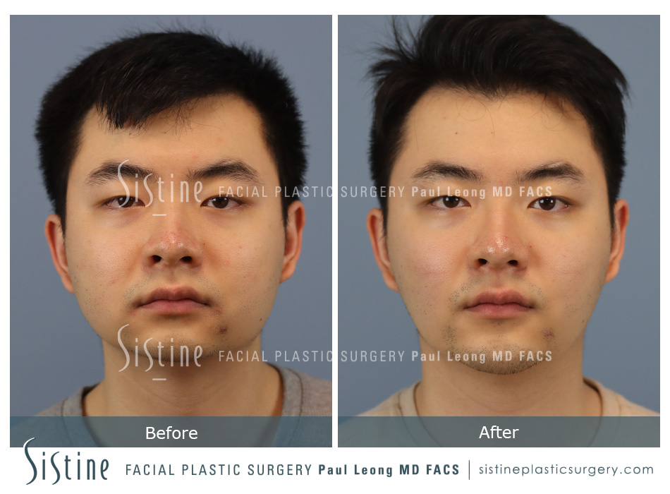 Buccal Fat Removal Before and After | Leong Facial Plastic Surgery