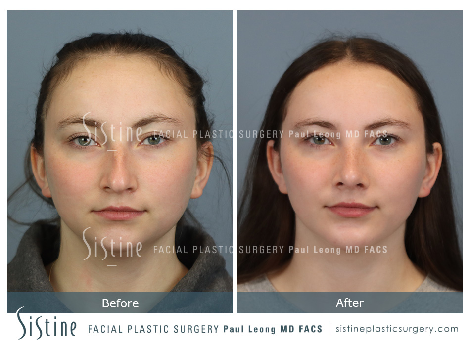 Chin Implant Before and After | Leong Facial Plastic Surgery