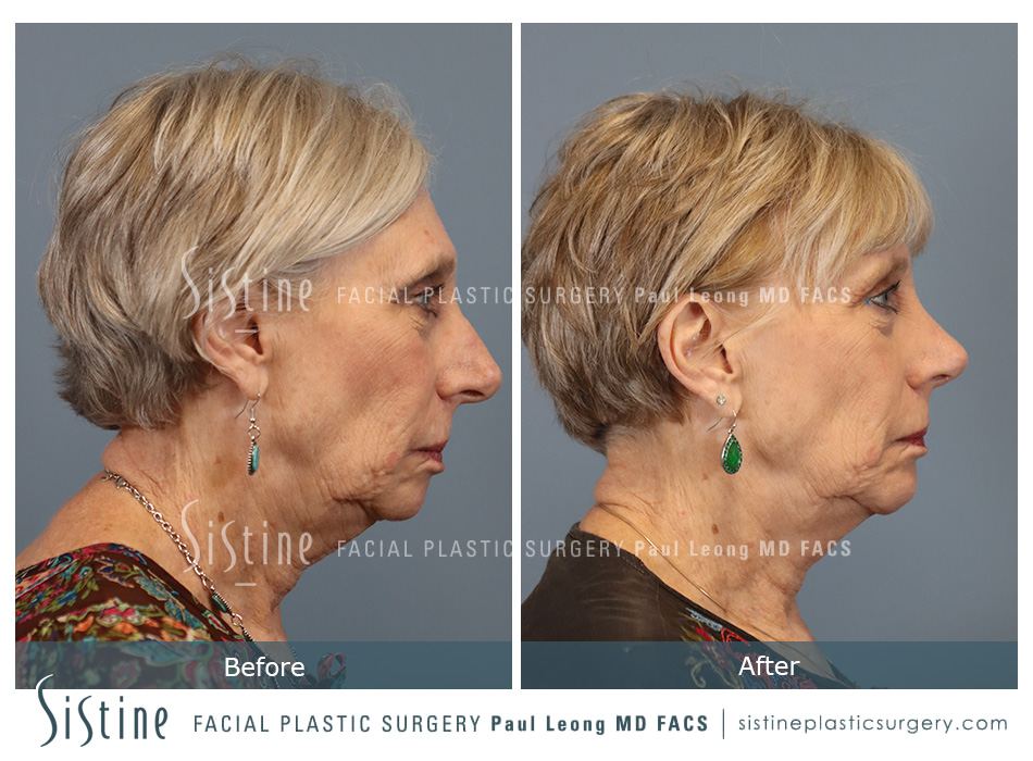 Chin Implant Before and After | Leong Facial Plastic Surgery