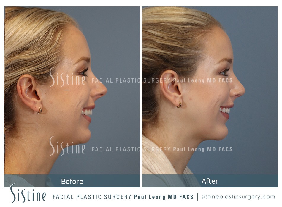 Chin Implant Before and After | Leong Facial Plastic Surgery