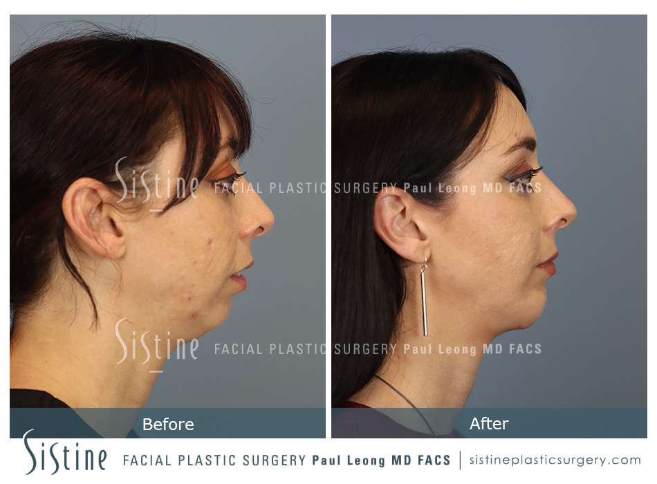 Chin Implant Before and After | Leong Facial Plastic Surgery